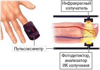 Виды пульсоксиметров