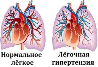 Кислородные концентраторы при легочной гипертензии