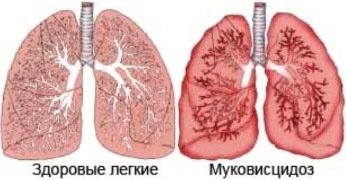 Кислородные концентраторы при муковисцидозе