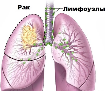 Концентраторы кислорода при опухоли легких